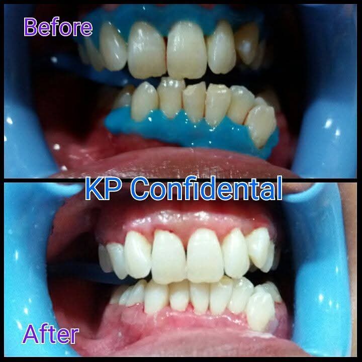 Before and after teeth whitening