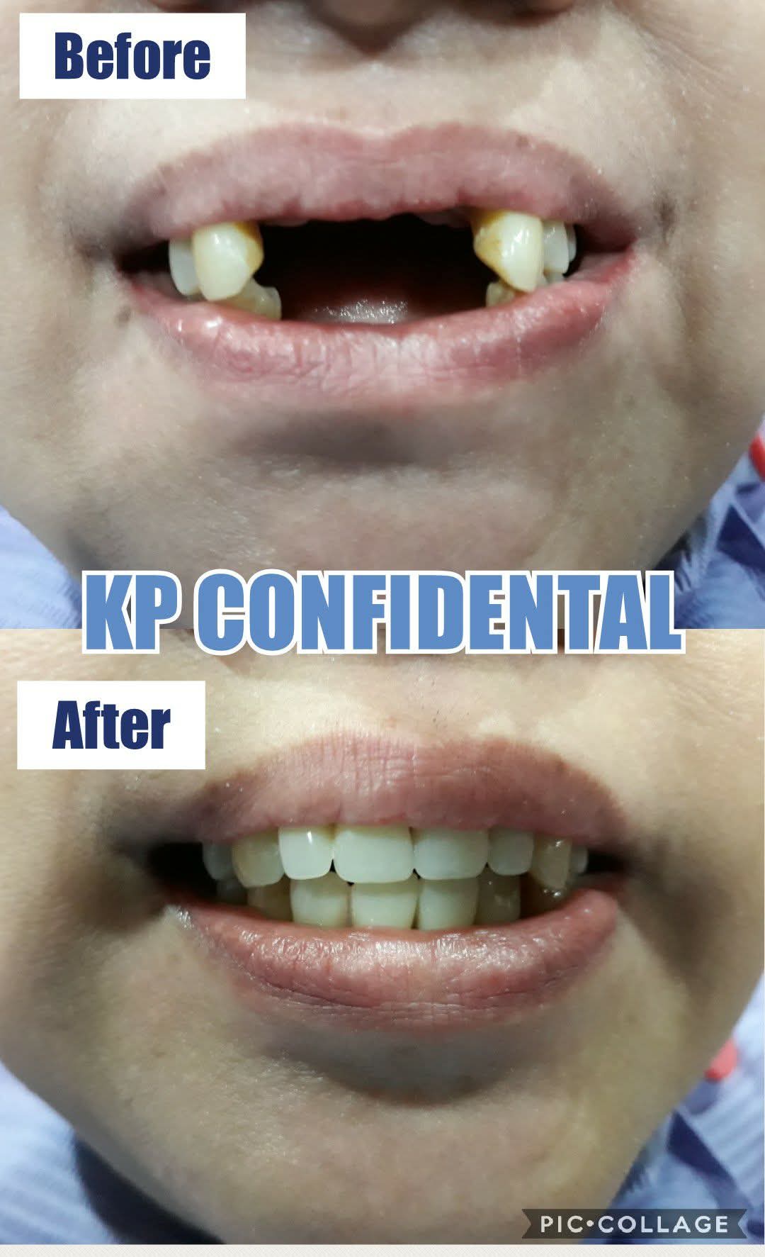 Before and after dentures and bridgework