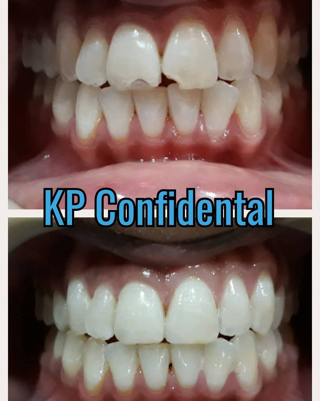 Before and after professional whitening