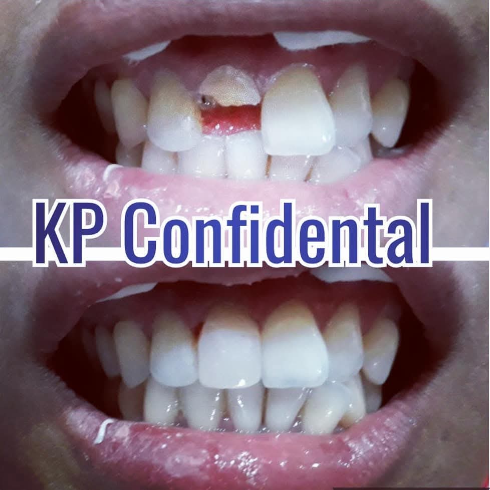 Before and after chipped tooth repair
