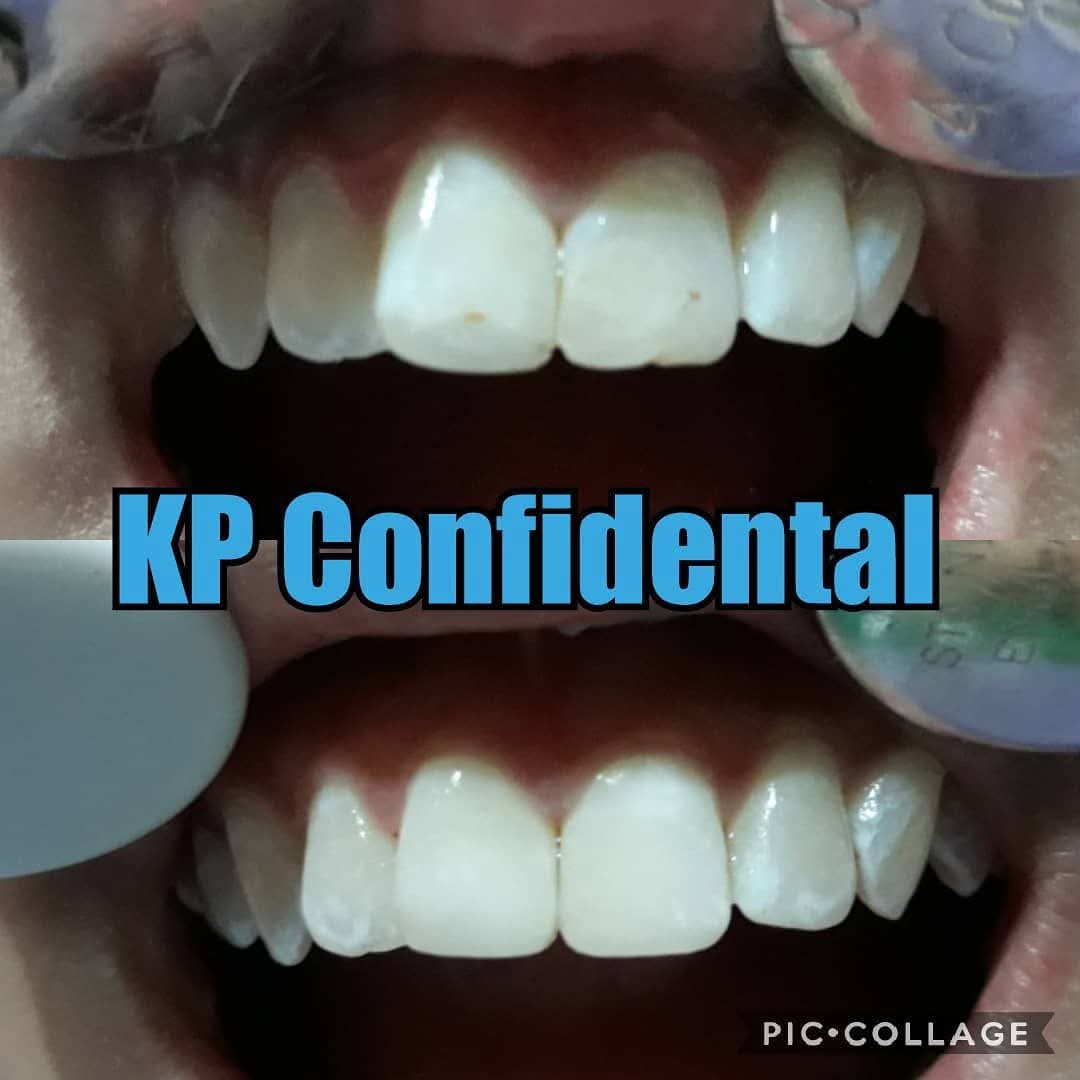 Before and after whitening