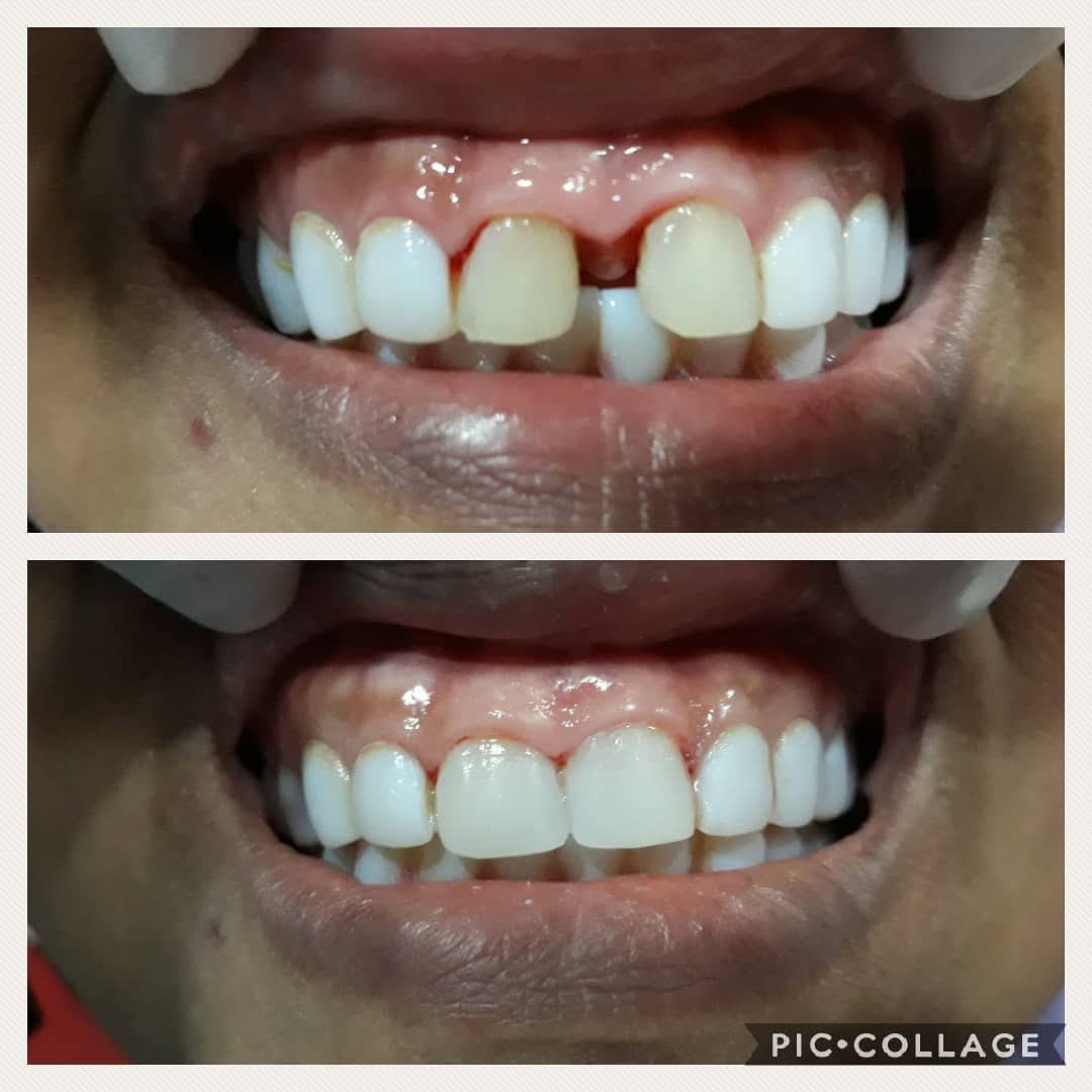 Before and after gap closure